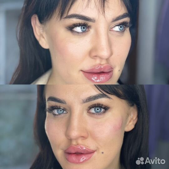Косметолог. Увеличение губ