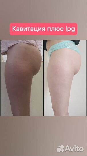 Лпдж массаж