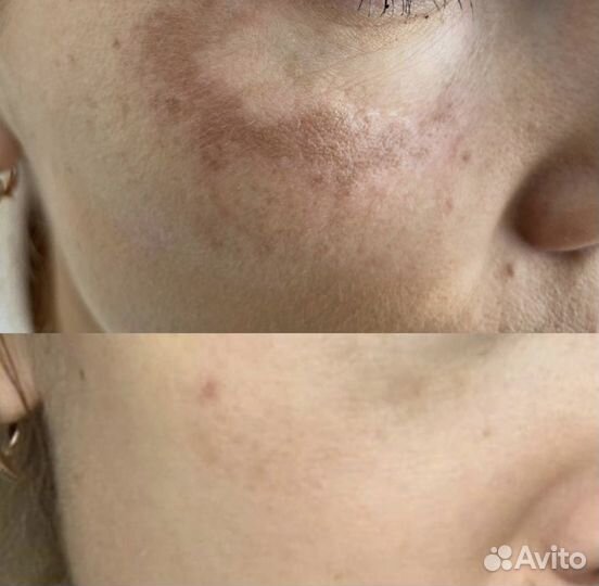 Лазерная эпиляция, элос эпиляция, элос омоложение