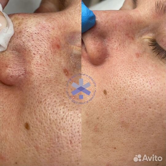 Чистка лица