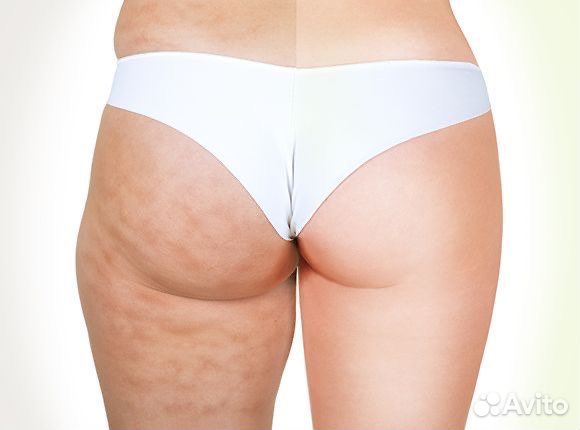 Массаж LPG (оригинальный аппарат keymodule )