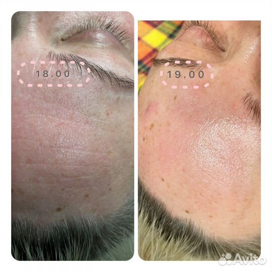 Испанский хиропластический массаж лица