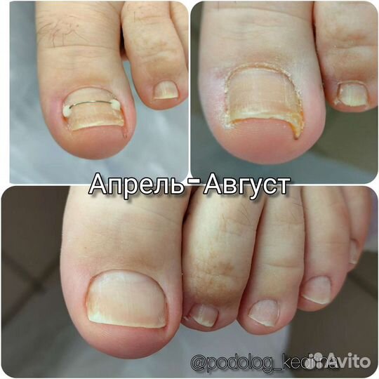 Подолог, педикюр парамед