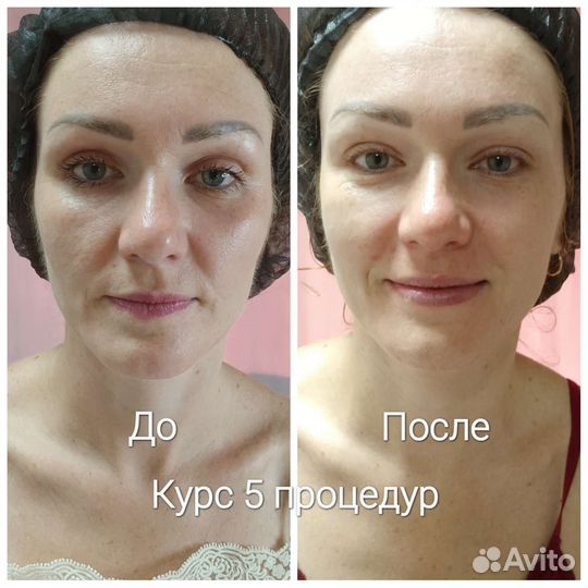 Массаж лица,Рф лифтинг лица.Микротоки