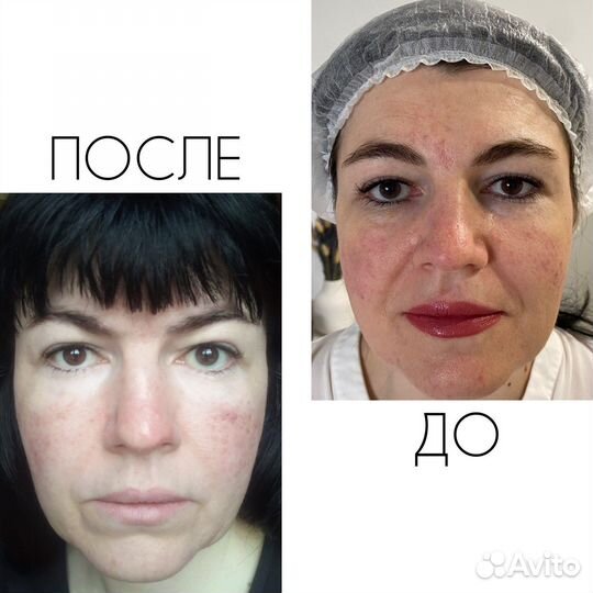 Скульптурно-буккальный массаж лица