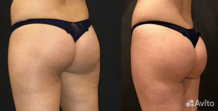 Похудение Турбо-Жиротоп Липосоник