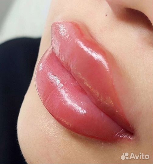 Увеличение губ