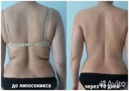 Липосоникс