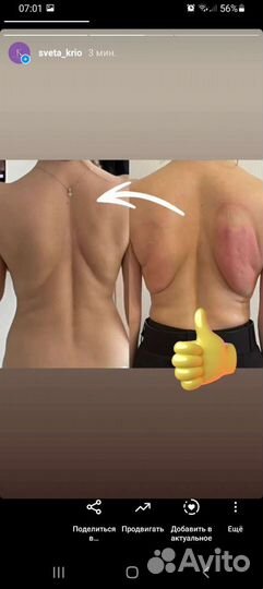 Криолиполиз