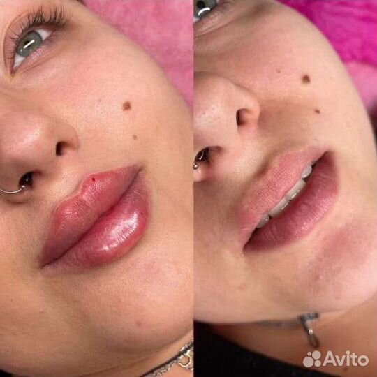 Увеличение губ