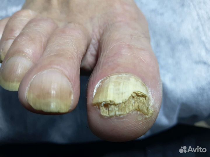 Парамедицинский педикюр подолог