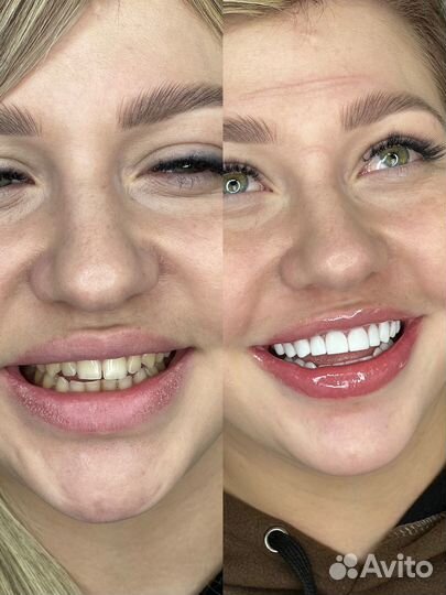 Зубной техник Виниры Коронки