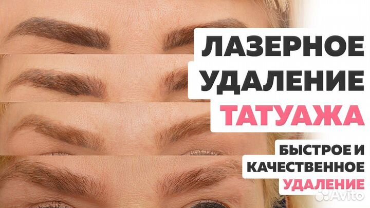 Удаление татуажа