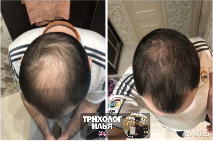 Трихолог (Остановлю Облысение) дистанционный