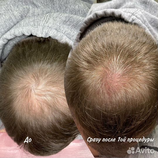 Камуфляж шрама/ ареолы/витилиго/татуаж тату