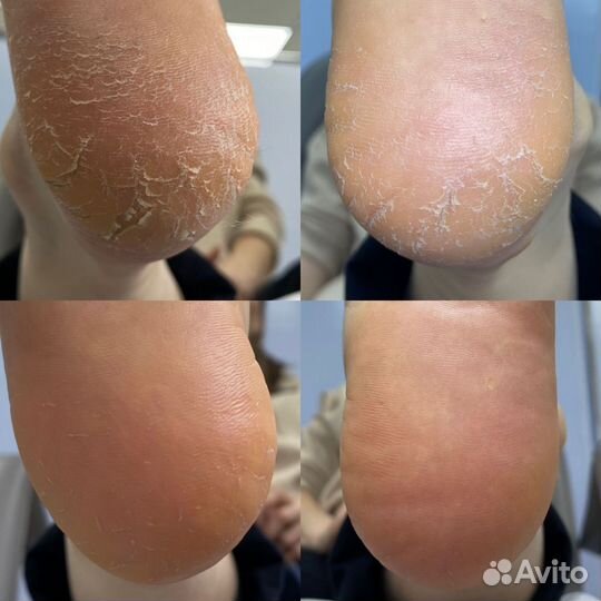 Подолог. Педикюр. Титановая нить