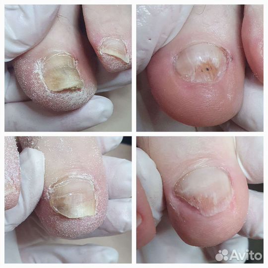 Лечение вросших ногтей