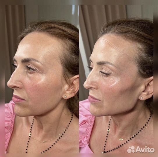 Full face, косметолог обучение, увеличение губ
