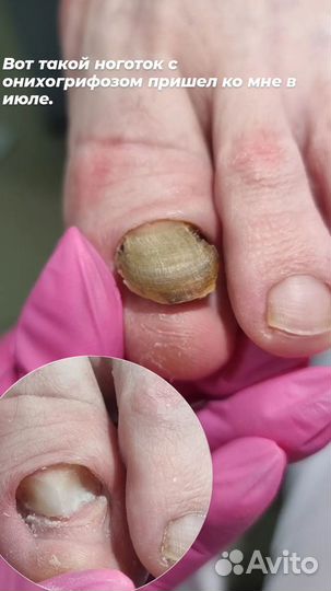 Лечебный педикюр подолог