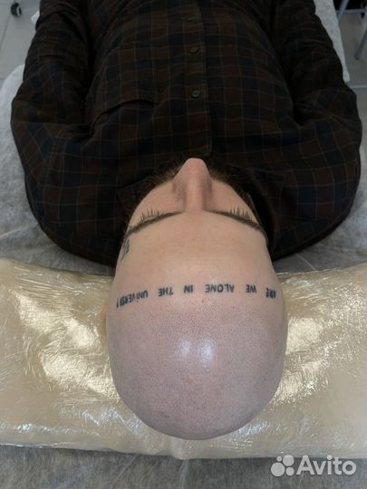 Трихопигментация головы, метод SMP