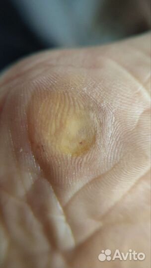 Педикюр подолог