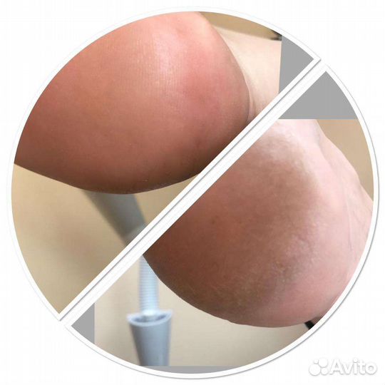 Педикюр аппаратно-препаратный