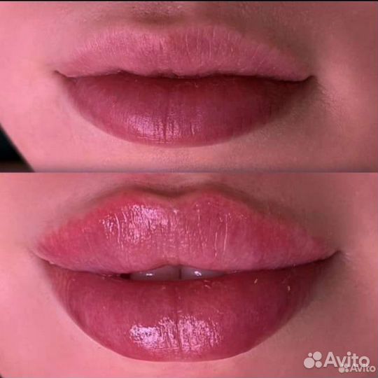 Увеличение губ