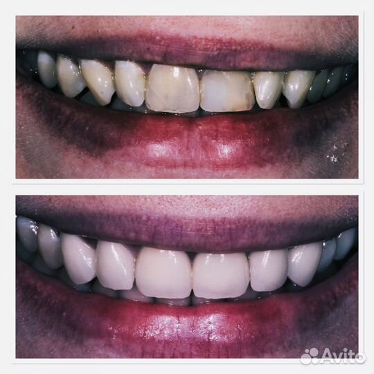 Услуги зуботехнической лаборатории(зубные протезы)