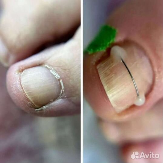 Подолог мозоли натоптыши грибки и др