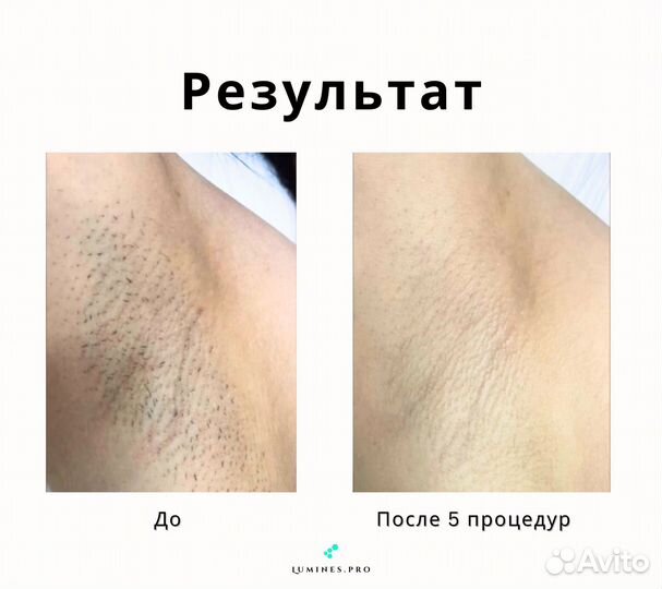 Аппарат для эпиляции Lumines-M MaxOne 1200вт