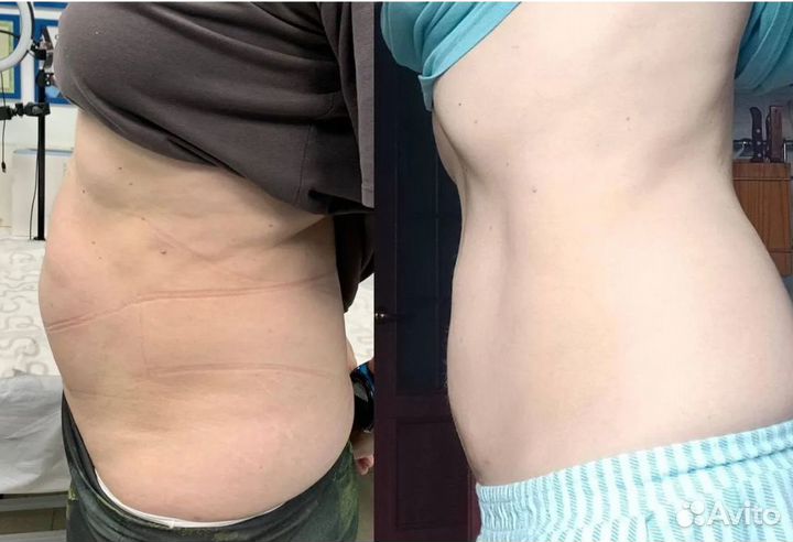 Плоский живот - размер за 1 процедуру