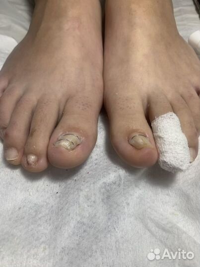 Подолог / Лечебный педикюр / Медицинский педикюр