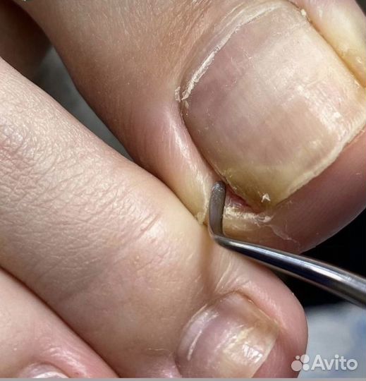 Подология Педикюр Маникюр Вросшие ногти Мазоли