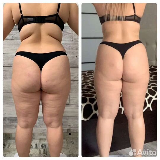 Lpg массаж, уз кавитация, РФ лифтинг и т. д