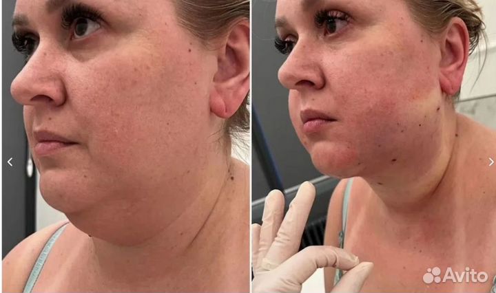 Супер омоложение и подтяжку лица без уколов