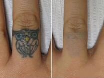 Удаление татуировок и перманентного макияжа