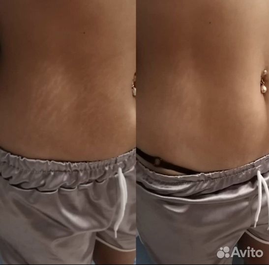 Удаление растяжек живот