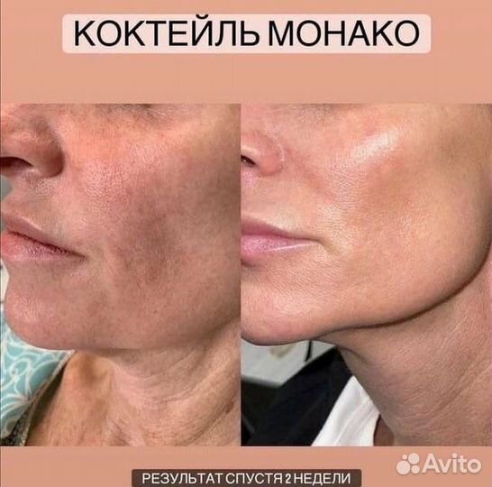 Королевский лифтинг 