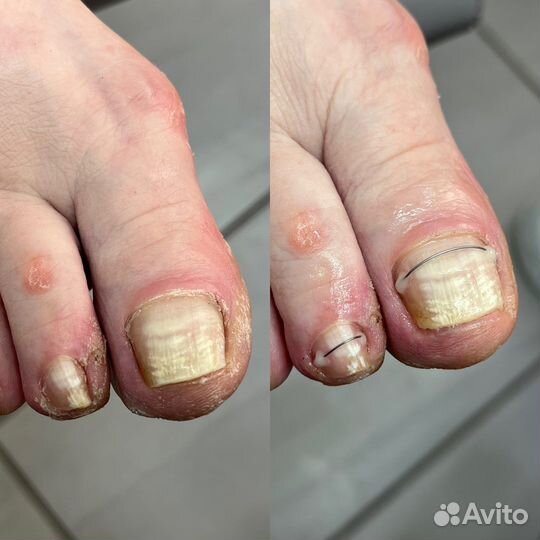 Подолог, медицинский педикюр