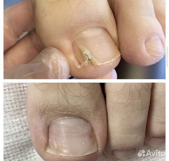 Педикюр подолог