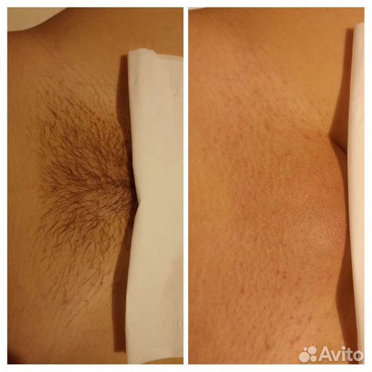 Шугаринг в солнечном