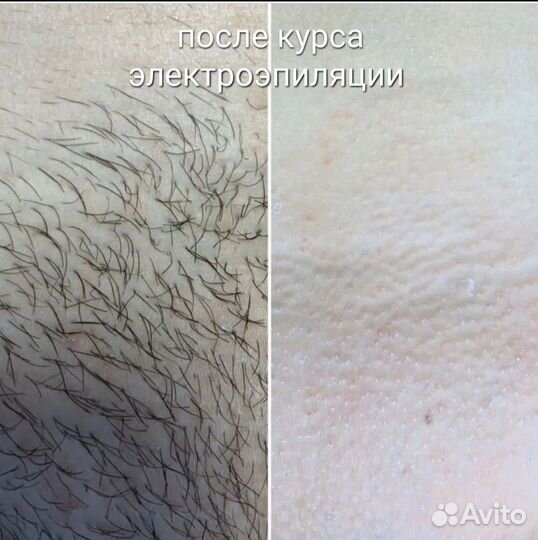 Электроэпиляция
