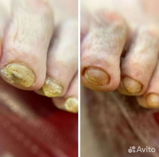 Подолог мозоли натоптыши грибки и др