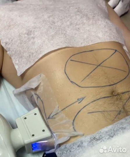 Криолиполиз похудение липосакция для мужчин