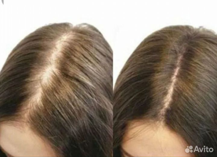 Восстановление роста и густоты волос