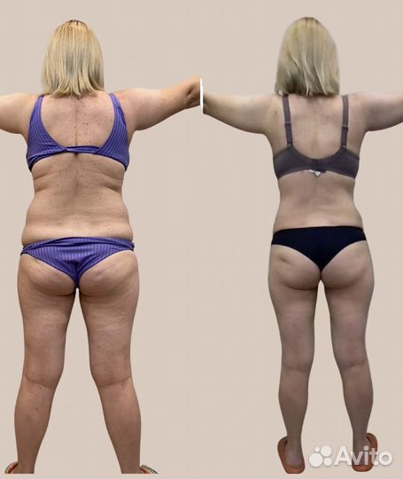 Аппаратное похудение