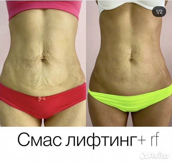 Подтяжка животика, смас лифтинг