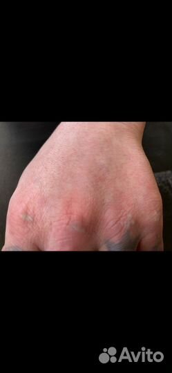 Удаление тату