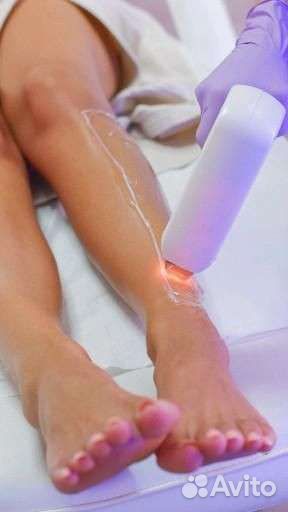 Лазерная эпиляция