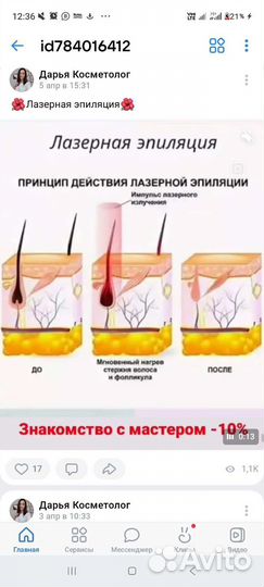 Лазерная эпиляция